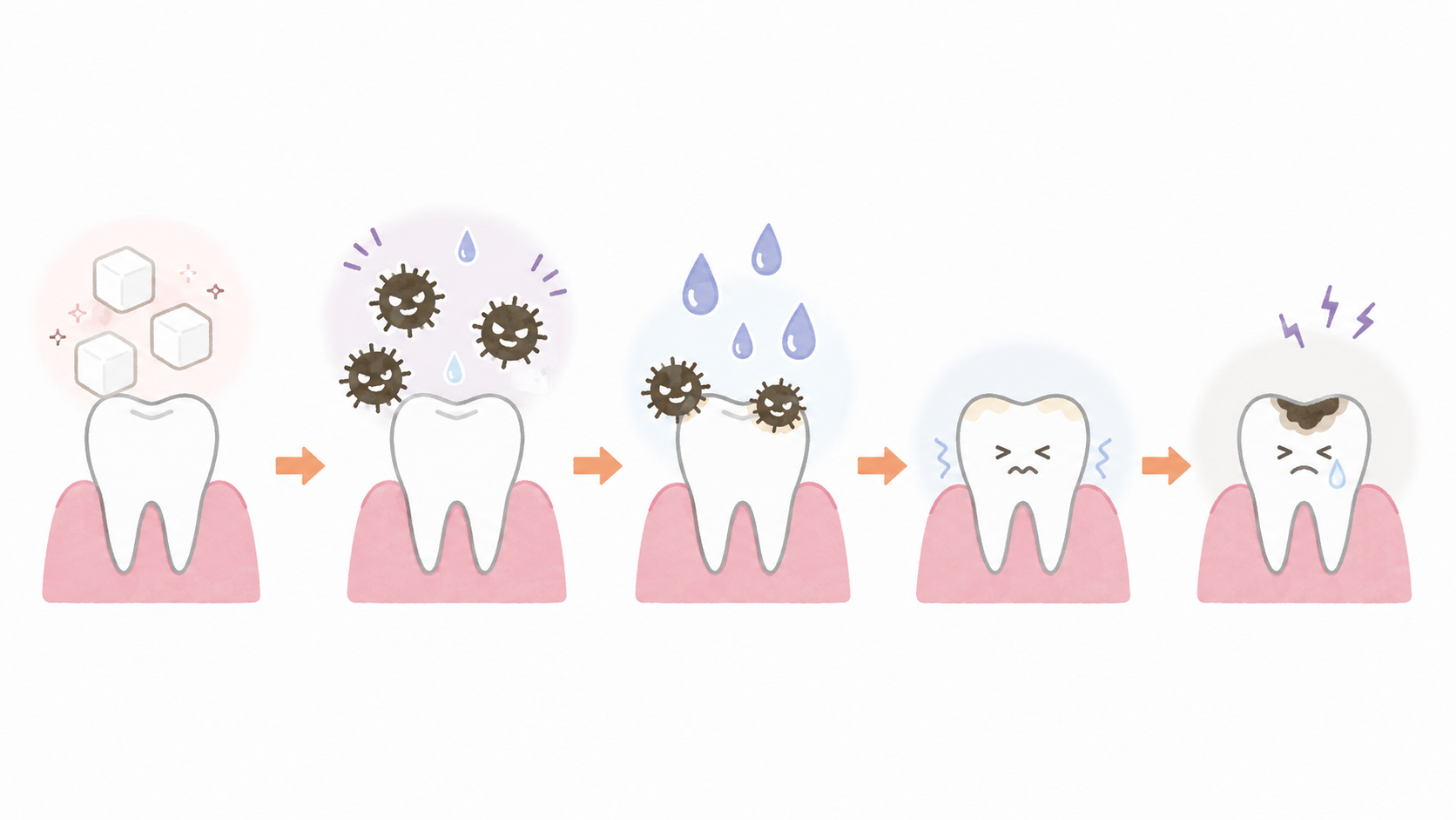 糖分から細菌が酸をつくり歯が溶けていく虫歯の仕組み